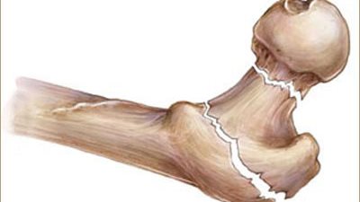 بذور السمسم حل سحرى لعلاج هشاشة العظام