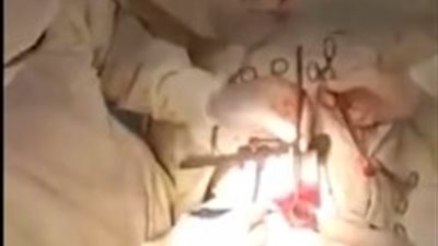 لقطات مرعبة للحظة إزالة الأطباء كرة شعر ضخمة من معدة فتاة (فيديو)