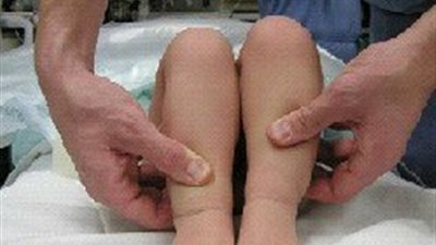 أخصائي عظام يكشف أعراض وعلاج خلع مفصل الحوض بالأطفال