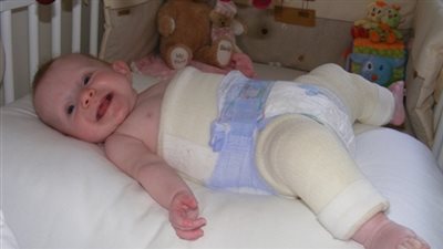 أخصائي عظام يكشف أسباب خلع مفصل الحوض عند الأطفال