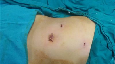 إجراء عملية استئصال مرارة لطفل لأول مرة بـ«تأمين القليوبية»