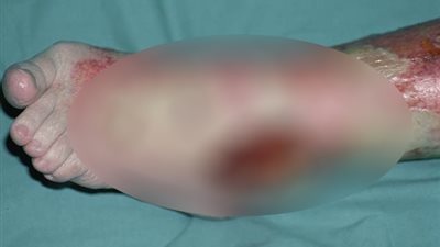 تحذيرات من تفشي وباء «قرحة بورولي» آكل لحوم البشر (فيديو)