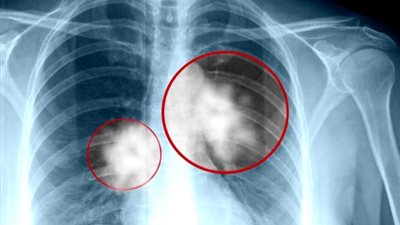 الجمعية الأمريكية لأبحاث السرطان تتوصل لأحدث دواء لأورام الرئة