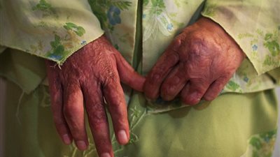 بالصور.. الإيرانيات يحرقن أنفسهن هربًا من الزواج المبكر