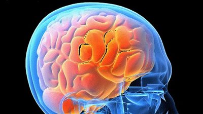 منظم لنشاط المخ يعالج فقدان الشهية العصبي