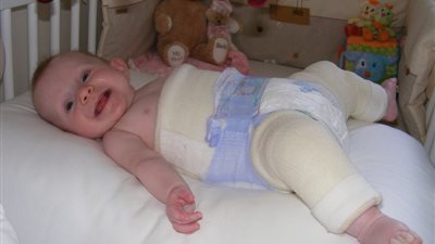 4 أسباب تؤدي إلى إصابة الأطفال بخلع مفصل الفخذ