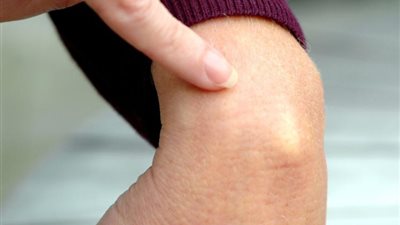 3 طرق تخلصك من ورم مفصل اليدين