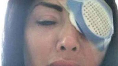 نهاية مروعة لعارضة أزياء حاولت تغيير لون عينيها