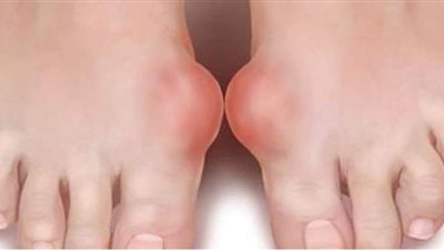 أعراض النقرس فى القدم