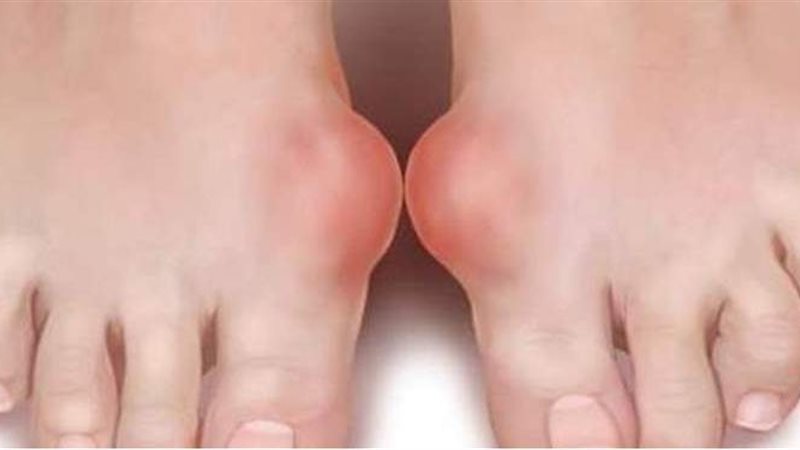 أعراض النقرس فى القدم