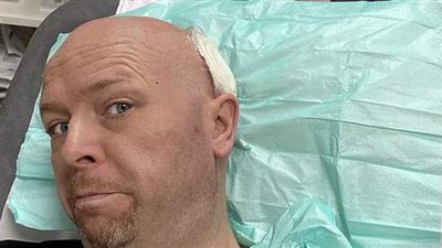 بطل جوت تالنت البريطانية.. يكشف محاربته سراً لسرطان الجلد