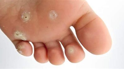 علاج مسمار اللحم وأسبابه وأعراضه