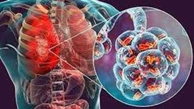 أعراض الالتهاب الرئوى