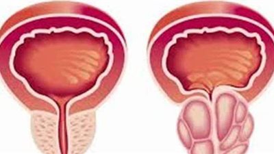 اعراض سرطان البروستاتا