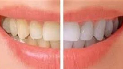 تفسير حلم تسوس الأسنان في المنام.. وعلاقته بالمشاكل الزوجية