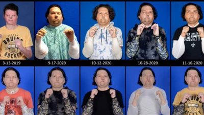 الثالثة من نوعها في العالم.. إجراء عملية نادرة لزرع وجه ويدين | فيديو وصور