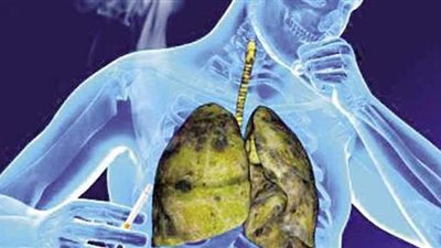 أعراض مرض السل وأسبابه وطرق العلاج