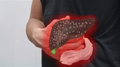 أعراض الكبد الوبائي وعلاجه