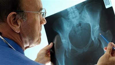 اعراض هشاشة العظام وأسباب الإصابة .. وطرق العلاج