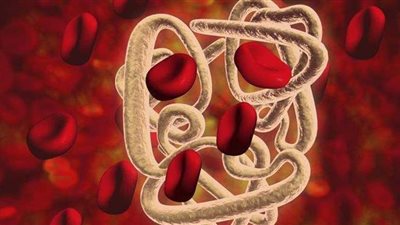 الأعراض والمخاطر.. مرض الثلاسيميا والزواج