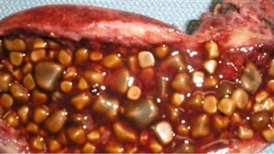 أعراض حصى المرارة وأسبابها وطرق العلاج