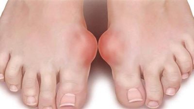 أعراض مرض النقرس