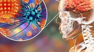 أسباب مرض الالتهاب السحائي وأعراضه