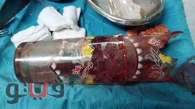 استخراج كوبين زجاجيين من قولون شاب في المنصورة التخصصي | صور