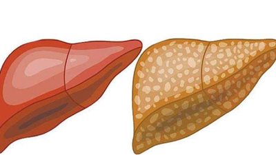 أعراض الكبد الدهني.. وأهم طرق العلاج