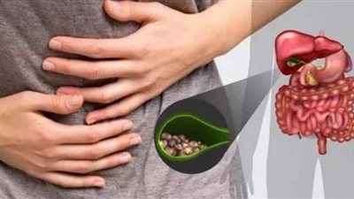 أعراض حصى المرارة.. وطرق العلاج من الطبيعة