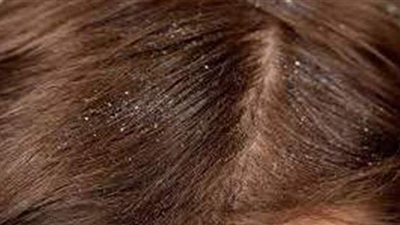 تفسير رؤية القمل في المنام.. وعلاقته بأصدقاء السوء والمال الحرام