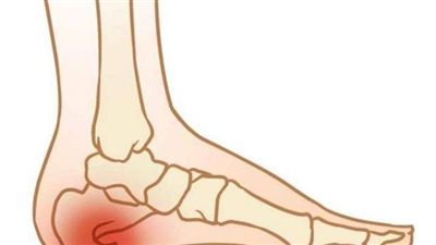الشوكة العظمية.. الأعراض والعلاج وطرق الوقاية