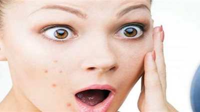 خبيرة تغذية توضح الأطعمة التي تسبب ظهور حب الشباب