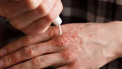 القومى للبحوث يفتتح عيادة لاستقبال وعلاج مرضى الصدفية