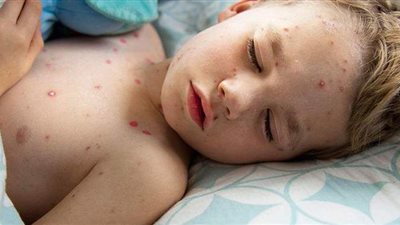 تعرف على أسباب الإصابة بمرض الجدري المائي.. الأعراض والعلاج