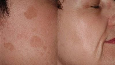 أفضل العلاجات المنزلية لبقع الوجه البنية