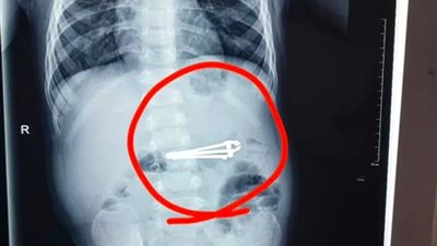 طفل شقي عمره عام يبتلع «قصافة أظافر» (فيديو)