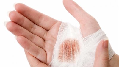 علماء أمريكيون يتوصلون لدور بروتين يعرقل التئام الجروح