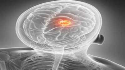 باحثون: الرجال أكثر إصابة بأورام المخ من النساء