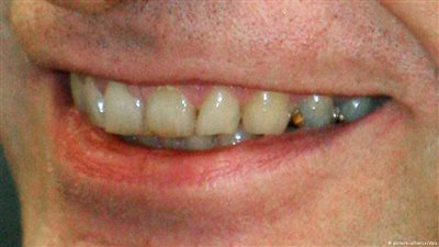 أمراض اللثة تنبئ بسرعة تدهور حالات المصابين بالزهايمر