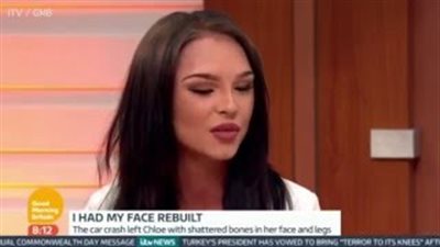 بالفيديو والصور.. فتاة تعود إلى الحياة بوجه جديد بعد 8 سنوات من الآلام