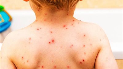 ١٥ يوم إجازة للتلاميذ المصابين 