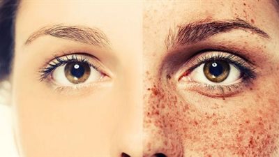 ماسك طبيعي لبشرة خالية من البقع البنية