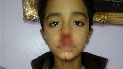 والدة تلميذ بالغربية تتهم مدرسا بالتسبب في إصابته بنزيف وتبول لا إرادي