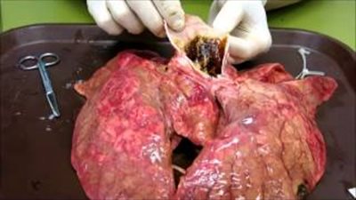 فيديو مرعب يكشف تأثير 60 سيجارة فقط على رئتيك