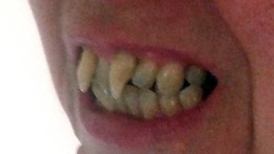 بالصور.. امرأة تتحول لمصاصة دماء بسبب خطأ طبي