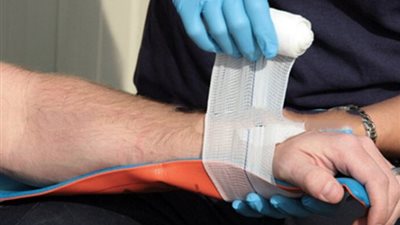 تثبيت كسر العظام يحمي من الإصابة بـ 5 أمراض خطيرة