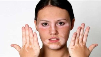 كيف تحمي نفسك من الإصابة بمرض البهاق.. السر في فيتامين د