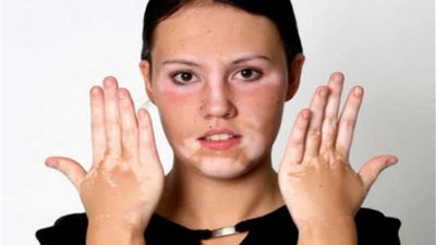 هل البهاق معدي | خبير نباتات طبية يجيب