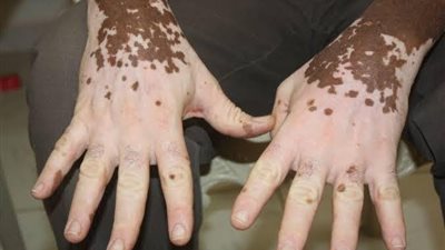 4 نصائح تحمي من الإصابة بالبهاق